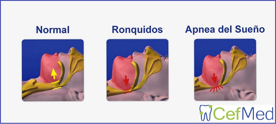 tratamiento de apnea obstructiva del sueño